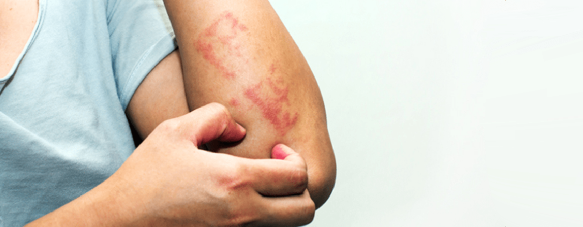 Psoriase como tratar atraves da dermatologia - Blog Scipioni