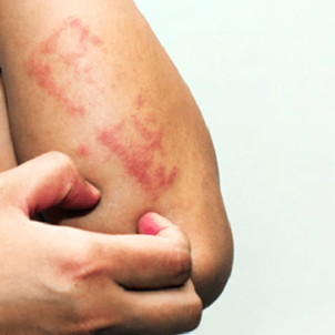 Psoriase como tratar atraves da dermatologia - Blog Scipioni